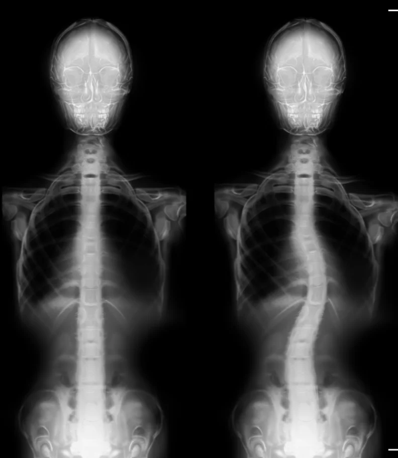 scoliosis Raleigh NC